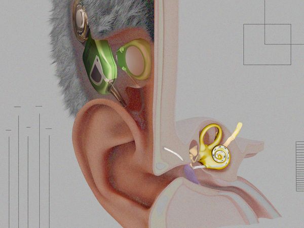 全球首款全植入式人工耳蜗问世,患者实现全天候隐形听力