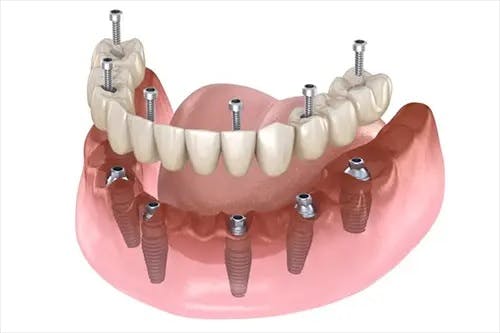 Dental Implants